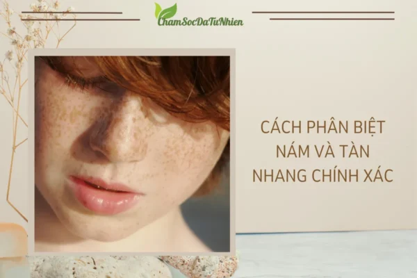 Cách Phân Biệt Nám và Tàn Nhang Chính Xác (1)