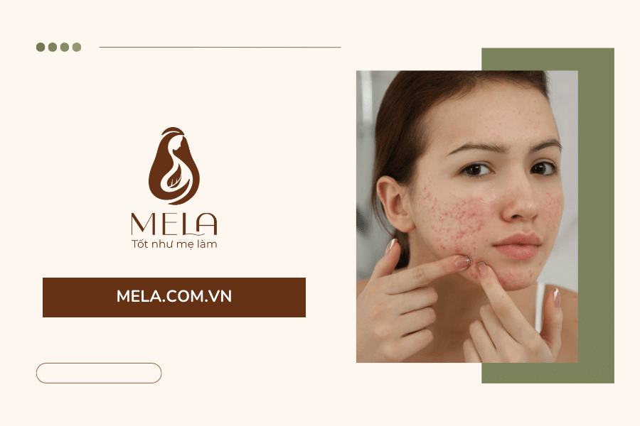 Những điều cần lưu ý khi tẩy tế bào chết da mụn