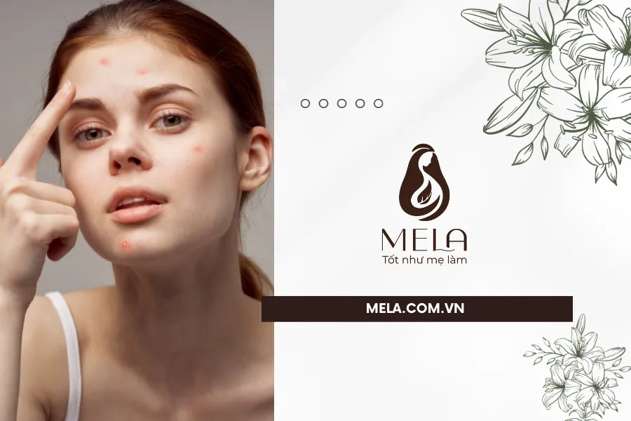 Da mụn có nên tẩy tế bào chết không?