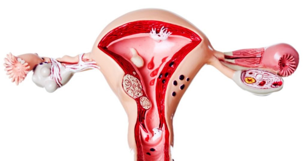 Lạc nội mạc tử cung được xem là nguyên nhân gây đau khi rụng trứng