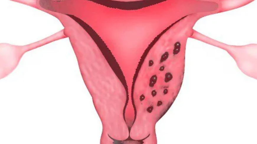 Lạc nội mạc tử cung có thể là nguyên nhân gây suy hoàng thể