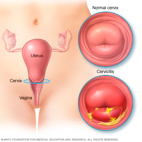 uterine infections
