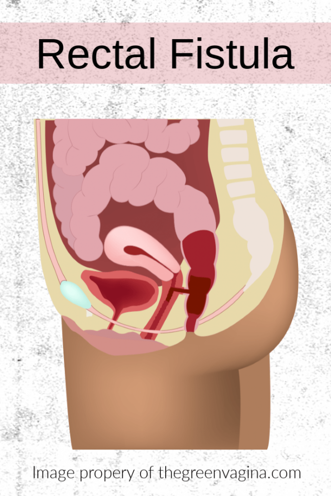 Các loại lỗ rò âm đạo liên quan đến đường ruột: