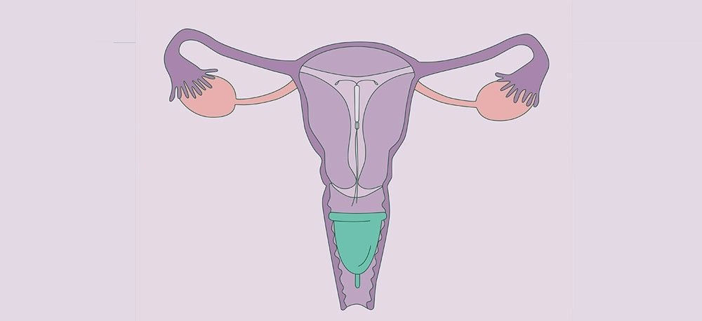 Có thể sử dụng cốc nguyệt san và vòng tránh thai IUD cùng lúc được không?