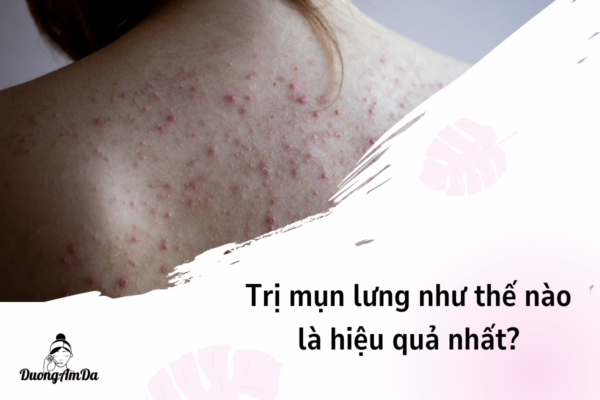 Trị mụn lưng như thế nào là hiệu quả nhất