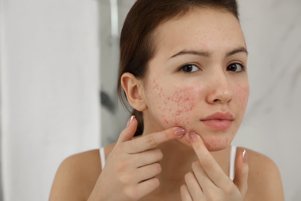 Bí kíp chăm sóc da sau nặn mụn Ngăn ngừa thâm và phục hồi da (2) Bí kíp chăm sóc da sau nặn mụn Ngăn ngừa thâm và phục hồi da (2)