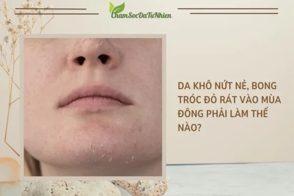 Da khô nứt nẻ, bong tróc đỏ rát vào mùa đông phải làm thế nào