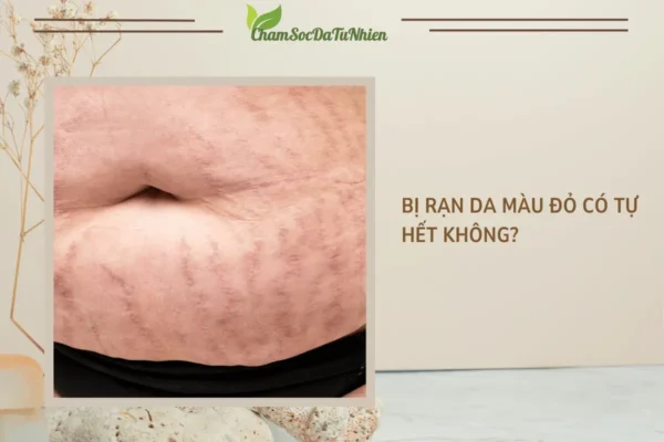 Bị rạn da màu đỏ có tự hết không