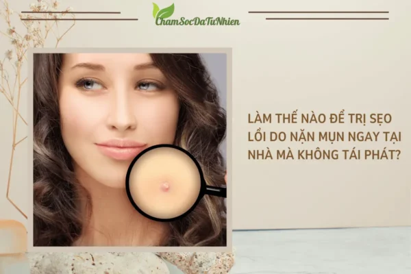 Làm thế nào để trị sẹo lồi do nặn mụn ngay tại nhà mà không tái phát
