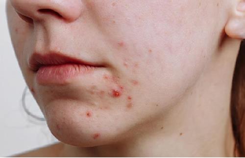 Cằm có mụn hoặc bị thương Cam co mun hoac bi thuong