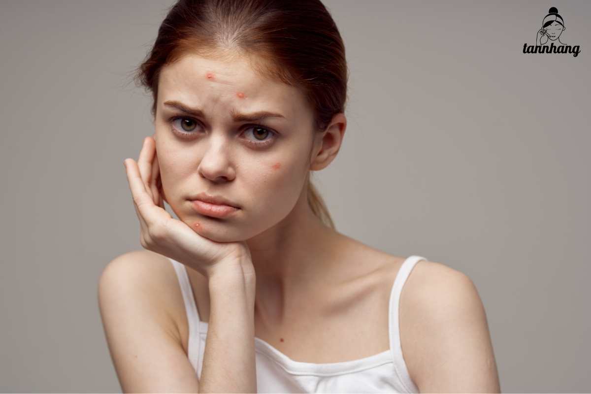 Trị mụn ẩn trên trán như thế nào là hiệu quả nhất (1)
