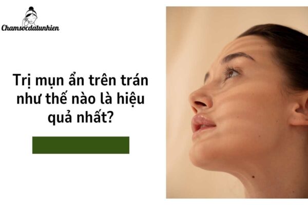 Trị mụn ẩn trên trán như thế nào là hiệu quả nhất (2)