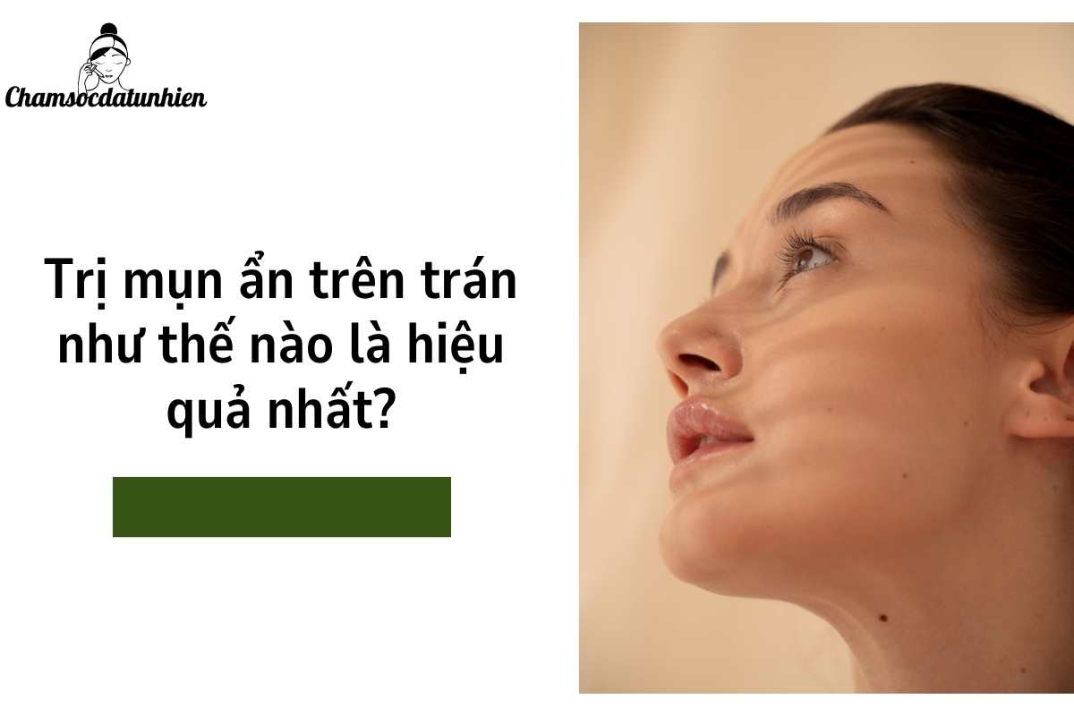 Trị mụn ẩn trên trán như thế nào là hiệu quả nhất (2)