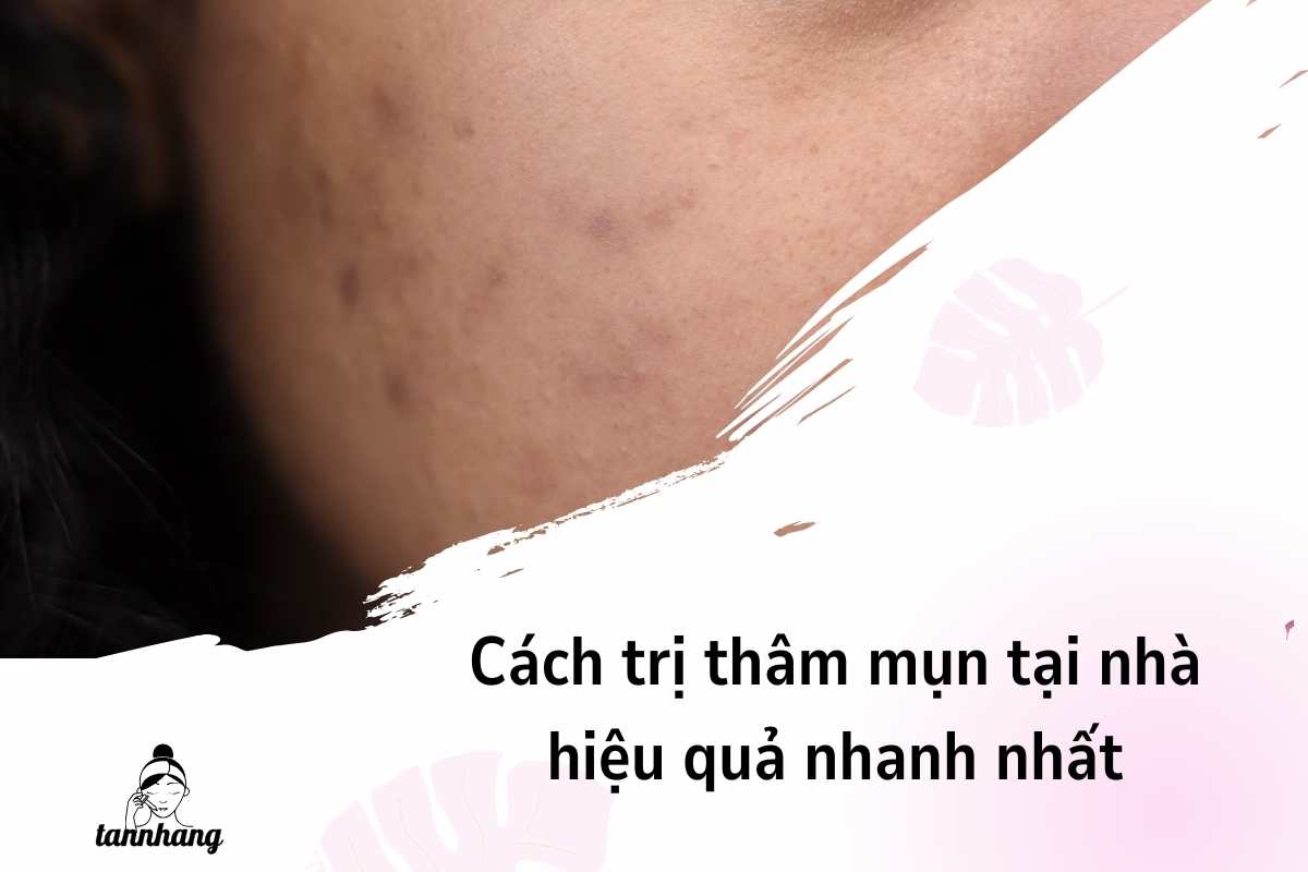 Cách trị thâm mụn tại nhà hiệu quả nhanh nhất