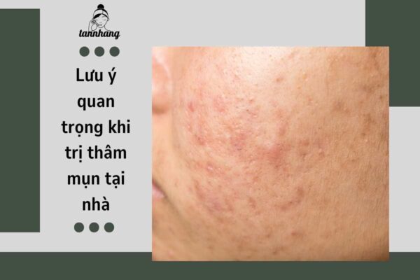 Lưu ý quan trọng khi trị thâm mụn tại nhà (2)
