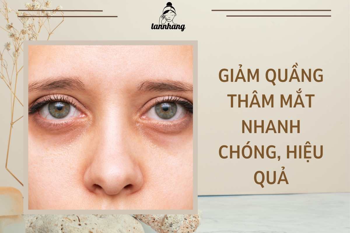 4 Cách giảm quầng thâm mắt bằng phương pháp dân gian