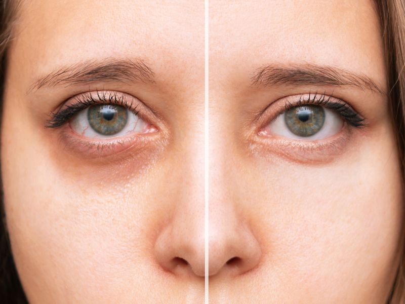 Tầm quan trọng của việc chăm sóc vùng da mắt