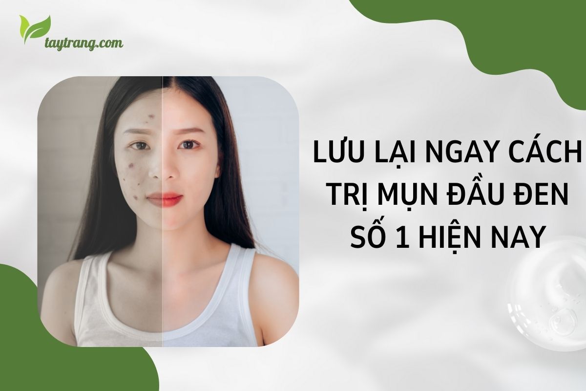 Lưu lại ngay cách trị mụn đầu đen số 1 hiện nay