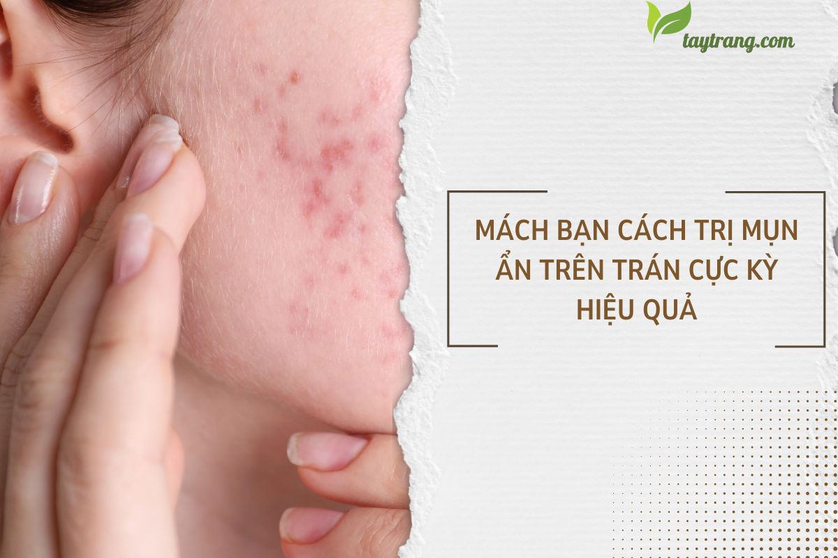 Mách bạn cách trị mụn ẩn trên trán cực kỳ hiệu quả