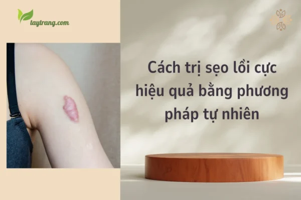 Cách trị sẹo lồi cực hiệu quả bằng phương pháp tự nhiên