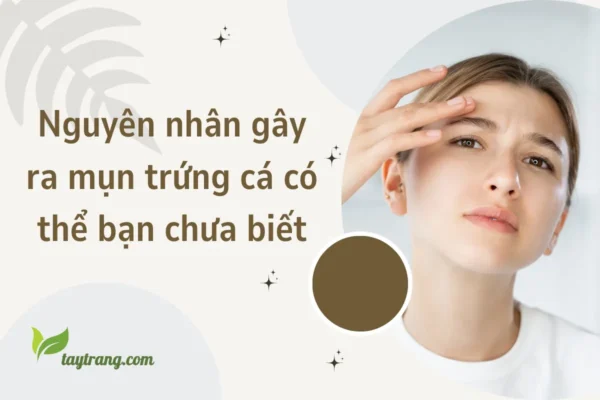 Nguyên nhân gây ra mụn trứng cá có thể bạn chưa biết