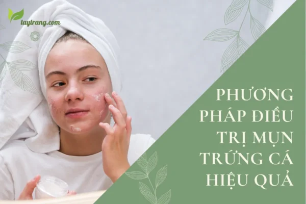 Phương pháp điều trị mụn trứng cá hiệu quả