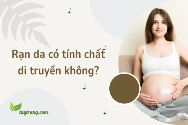 Rạn da có tính chất di truyền không