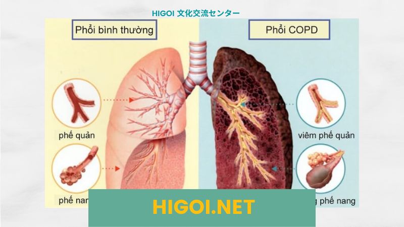 Bị lao phổi có được đi xuất khẩu lao động Nhật Bản?